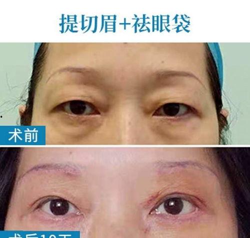 手术去眼袋视频,专业视角下的美丽蜕变