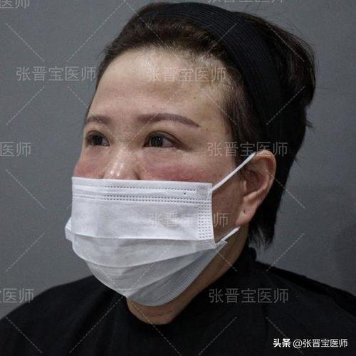 手术去眼袋视频,专业视角下的美丽蜕变